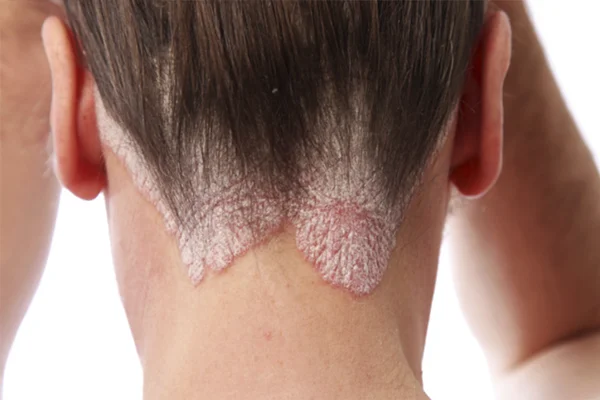 Psoriasis Acupuntura